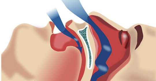 NightLase™ A patient oriented solution to decrease the volume of snoring Non-Surgical and Non-Invasive